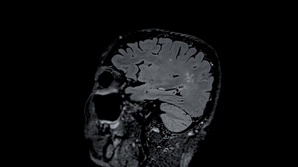 Is Your Car Accident Head Injury Mild or Severe? Free Consults